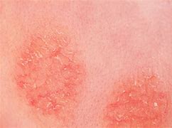 Image result for Eczema On Darker Skin