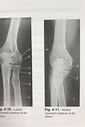 Image result for Lateral Knee Internal vs External Rotation