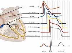 Image result for Heart Failure Electrocardiogram