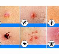 Image result for Treating Insect Bites