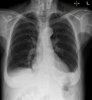 Image result for Pleural Effusion