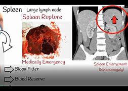 Image result for Spleen Disease Symptoms