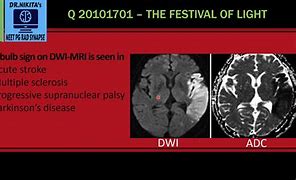 Image result for Light Bulb Sign Pheochromocytoma