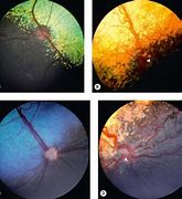 Image result for Enlarged Optic Nerve