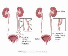 Image result for Long Tunnel Ureter