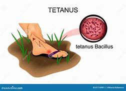 Image result for Tetanus Drawing