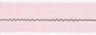 Image result for Ventricular Fibrillation EKG Examples