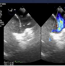 Image result for Ventricular Dilation