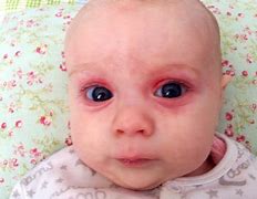 Image result for Baby Rash around Eyes