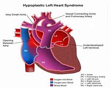 Image result for Left Ventricular Outflow Tract Stroke Volume