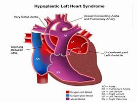 Image result for Anatomical Site of Left Ventricular Outflow Tract