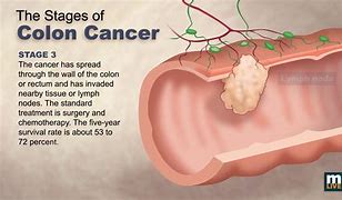 Image result for Human Body Colon Cancer