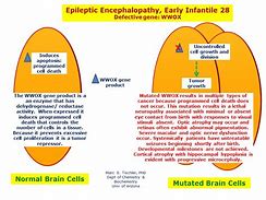 Image result for Pediatric Encephalopathy