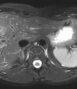 Image result for IRM Abdominale