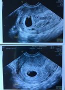 Image result for 6 Week HD Ultrasound