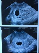 Image result for 6 Week Ultrasound Pictures