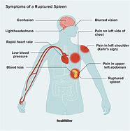 Image result for Spleen Disease Symptoms