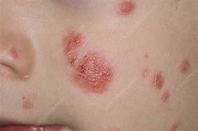 Image result for Psoriasis Bumps On Skin