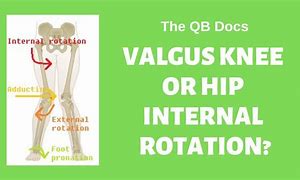 Image result for Lateral Knee Pain with Internal Rotation