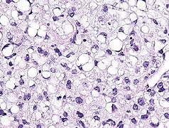 Image result for Myxoid Liposarcoma