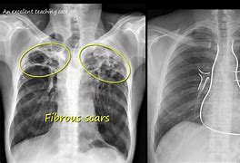 Image result for Chest X-ray of TB