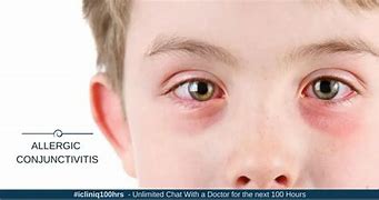 Image result for Allergic Conjunctivitis Treatment