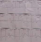 Image result for RVH ECG