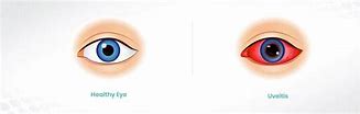 Image result for Uveitis Eye Disease