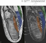 Image result for Plantar Foot Muscles