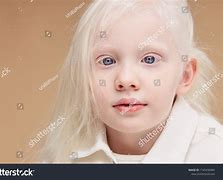 Image result for Albino Child