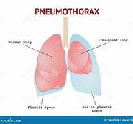 Image result for Signs of Collapsed Lung