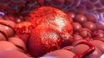 Image result for Human Tumor