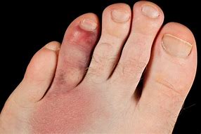 Image result for Broken Toe Bone