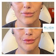 Image result for Versa Lip Filler