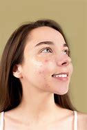 Image result for Pimple Face HD Images