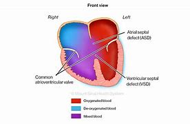 Image result for Tof with Atrioventricular Canal Defect