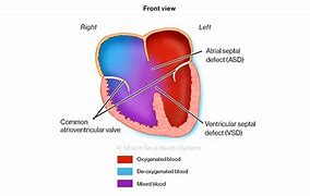 Image result for Complete Atrioventricular Canal Defect