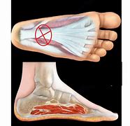 Image result for Medial Plantar Fascia