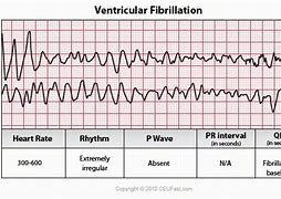 Image result for Course V-fib