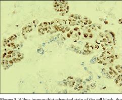 Image result for Acral Paresthesias