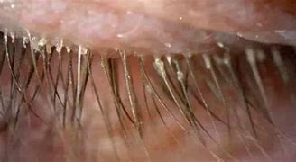 Image result for Head of Eyelaash Mites