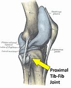 Image result for Deformity of Fibular Head