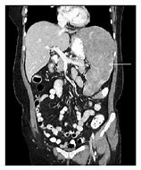 Image result for Spleen Enlargement CT