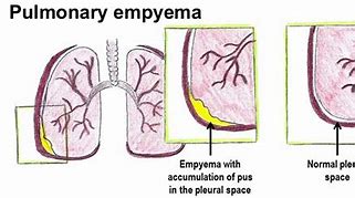 Image result for Right-Sided Empyema