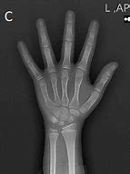 Image result for Bone Age Hand X-ray