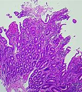 Image result for Duodenal Mucosa