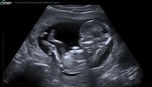 Image result for 13 Week Baby Ultrasound