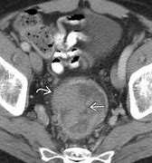 Image result for Adenocarcinoma Rectal Cancer