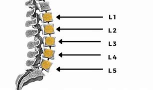 Image result for Lumbar Spine Herniation