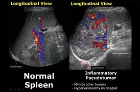 Image result for Spleen Infarction Ultrasound